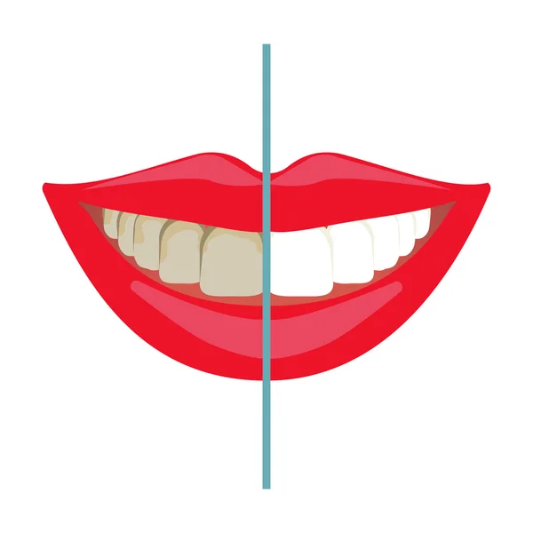 Zahnaufhellung ist die Folge. vor und nach Zahnaufhellung — Stockvektor