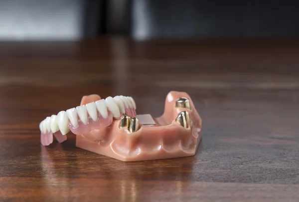 Primer plano de dentaduras postizas con dientes de oro —  Fotos de Stock