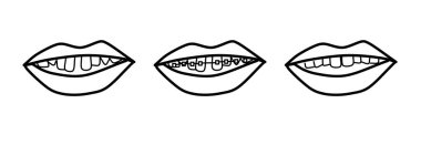 Estetik diş hekimliği ve ortodonti. Diş teli, beyaz arka planda izole edilmiş basamak çizim vektörü. Çarpık, güzel bir diş düzenleme, metal destekli. Doodle tarzı.