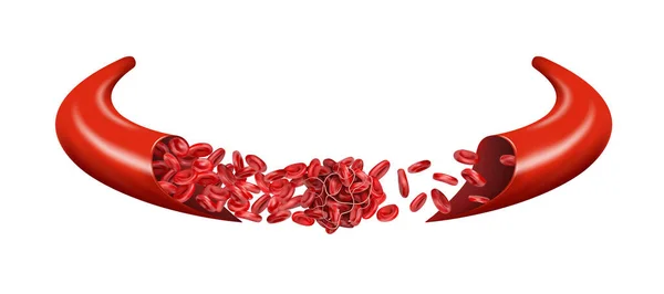 Coágulo Sangue Numa Veia Impede Fluxo Glóbulos Vermelhos Ilustração — Fotografia de Stock