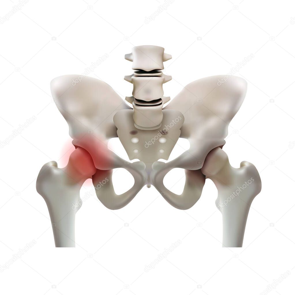 Arthritis of the hip joint on a white background. Illustration