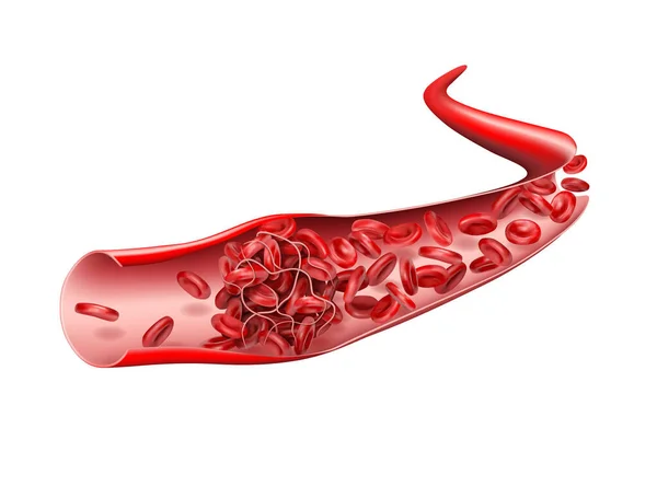 静脈内では 血栓が赤血球の流れを停止します 3Dベクトル図 — ストックベクタ