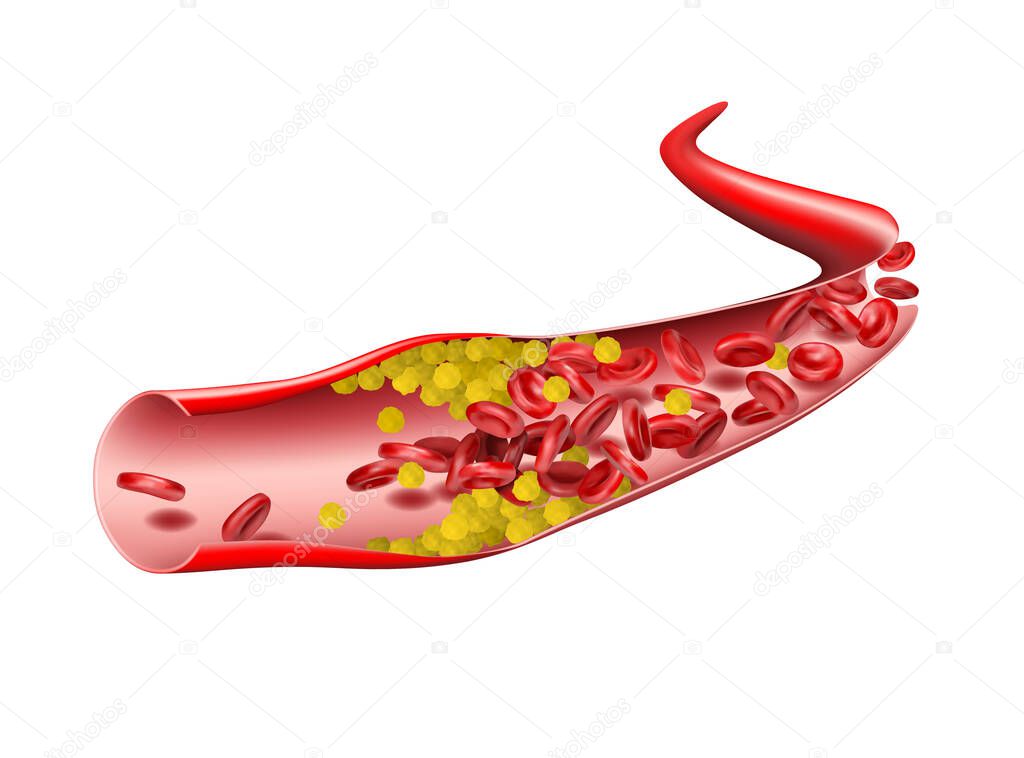In the vein, cholesterol stops the flow of red blood cells. Illustration