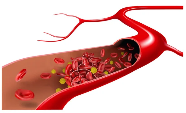 Damarda Kolesterol Eritrositlerle Akar Bir Kan Pıhtısı Oluşturur Vektör Illüstrasyonu — Stok Vektör