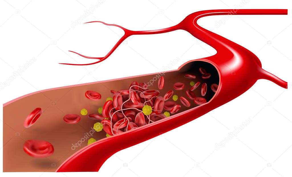 In the vein, cholesterol flows with erythrocytes and form a blood clot. 3d vector illustration