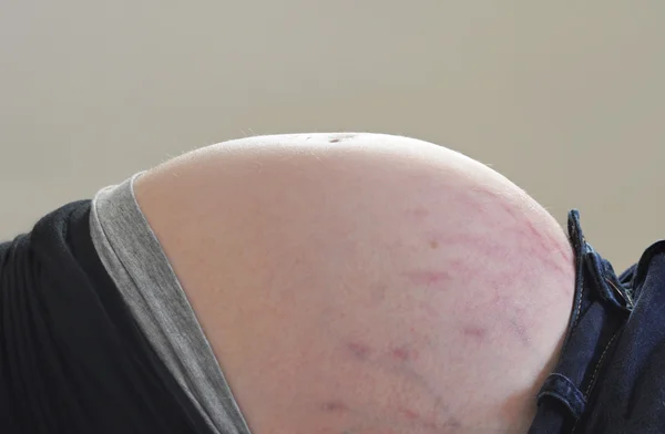 Hamile bir kadının karın çatlakları izleri