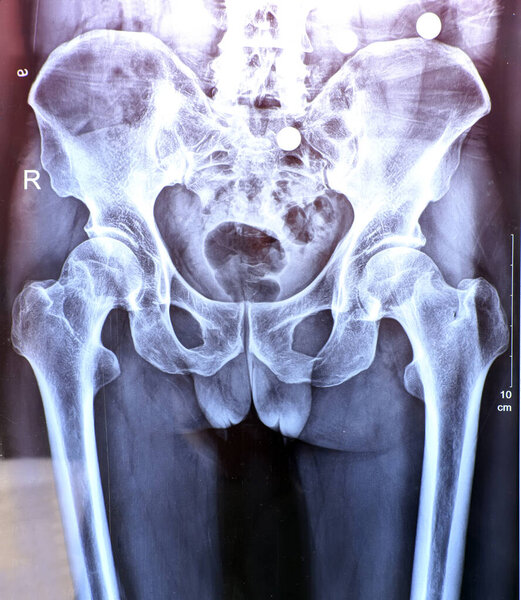 The X -ray of spine and pelvis
