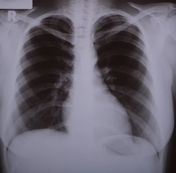 Рентгеновское изображение легких — стоковое фото