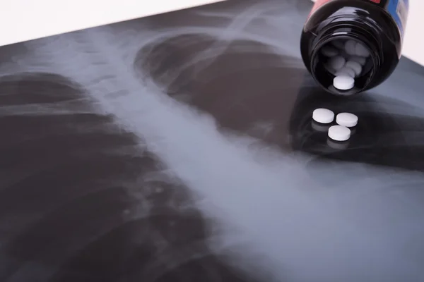 Hapları göğüs x-ray görüntüsü