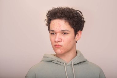 A young man in a green sweatshirt with problem skin, pimples and acne, large portrait. Concept of beauty, problem teenage skin, acne and pimples. High quality photo