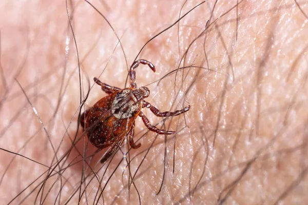 一个雌性吸血螨爬行在毛茸茸的人类皮肤上的宏观照片 危险的传染性寄生虫 — 图库照片