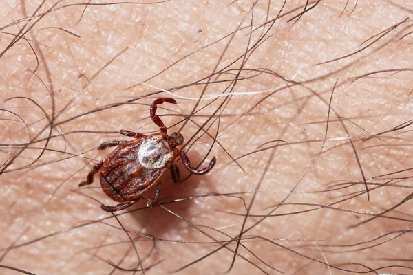 Blodsugande kvalster på en mänsklig hud makro — Stockfoto