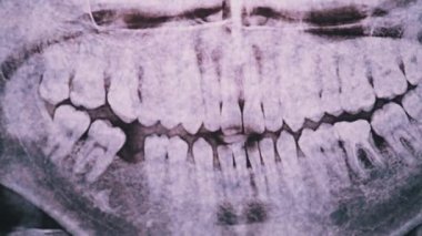 Çene ve Işığa Karşı Diş 'in dişçi röntgeni. Mühürlenmiş Azıdişleri. Radyografi