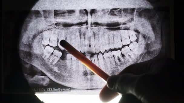 Tandheelkundige röntgenfoto van kaak met tanden. Verzegelde Molars. Tandarts onderzoekt de tandboog — Stockvideo