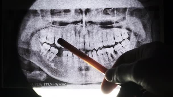 Prześwietlenie szczęki zębami. Zamknięte Molars. Dentysta bada łuk dentystyczny — Wideo stockowe