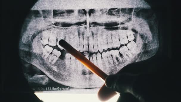 Radiografía dental de mandíbula con dientes. Molares sellados. Dentista examina el arco dental — Vídeos de Stock