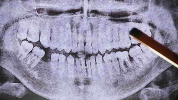 Teeth 와 Jaw 의 Dental X-Ray 입니다. 투명 한 나방. 치과 의사가 치과 교정을 검사하다 — 비디오