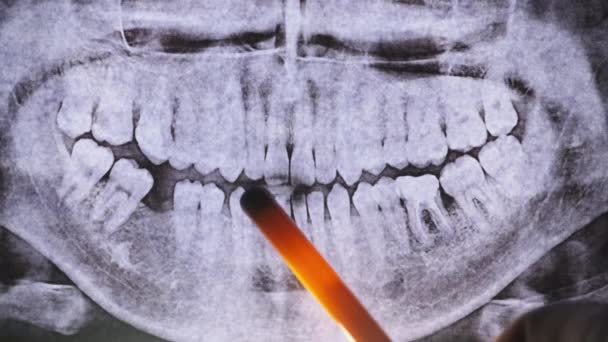 Зубний рентгенівський промінь джазу з зубами. Запечатані моляри. стоматолог оглядає стоматологічну арку — стокове відео