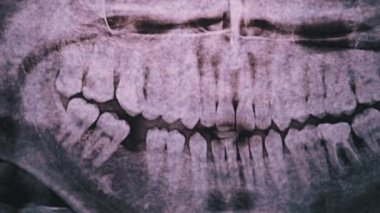 Çene ve Işığa Karşı Diş 'in dişçi röntgeni. Mühürlenmiş Azıdişleri. Radyografi