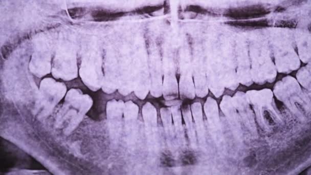 Prześwietlenie szczęki zębami przeciwko Światłu. Zamknięte Molars. Radiografia — Wideo stockowe