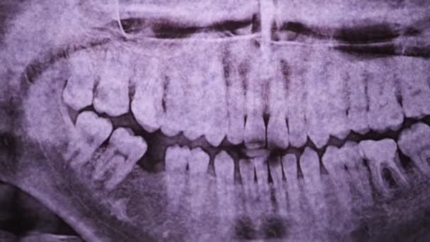 Röntgenfoto van de kaak met tanden tegen het licht. Verzegelde Molars. Radiografie — Stockvideo