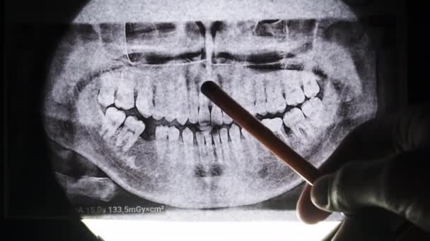 Radiographie dentaire de la mâchoire avec dents. Molaires scellées. Le dentiste examine l'arche dentaire — Video