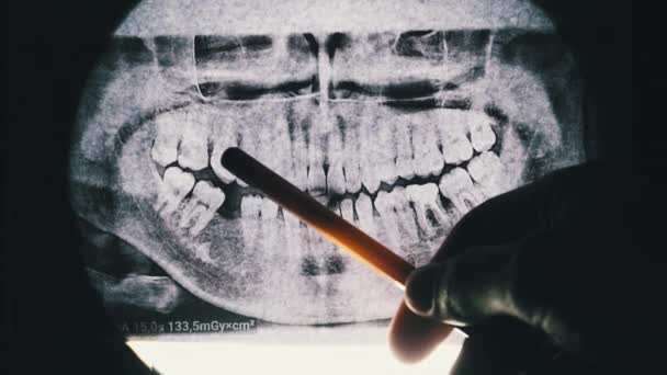 Radiographie dentaire de la mâchoire avec dents. Molaires scellées. Le dentiste examine l'arche dentaire — Video