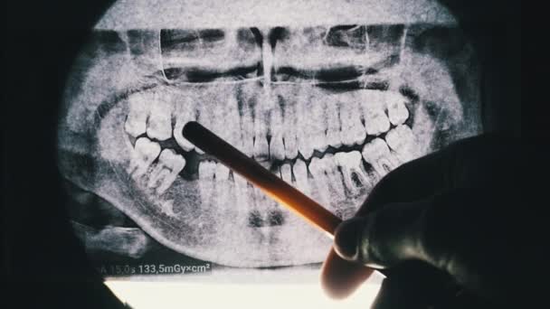 Zahnröntgen des Kiefers mit Zähnen. Versiegelte Backenzähne. Zahnarzt untersucht den Zahnbogen