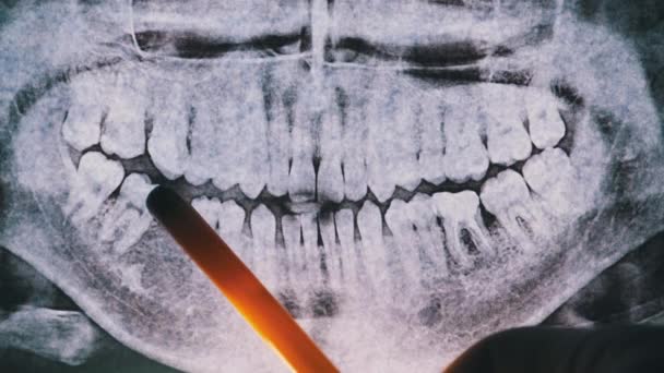 Radiographie dentaire de la mâchoire avec dents. Molaires scellées. Le dentiste examine l'arche dentaire — Video