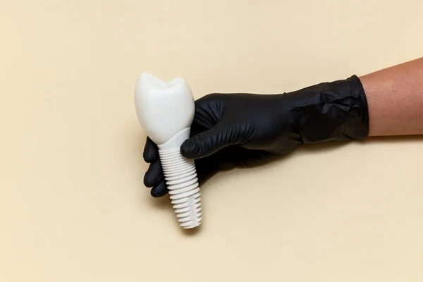 黒い医療用手袋の女性の手はベージュの背景に歯科インプラントを保持しています 人工歯の歯科インプラントモデル 歯科医療器具の概念 テキストとデザインのための場所と写真 — ストック写真