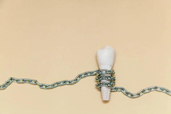 Implant Stomatologiczny Jest Skręcony Metalowym Łańcuchem Beżowym Tle Model Implantu — Zdjęcie stockowe