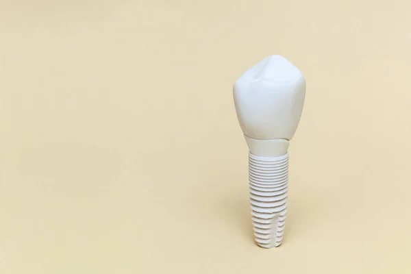 Implants Dentaires Sur Fond Beige Modèle Implant Dentaire Dent Artificielle — Photo