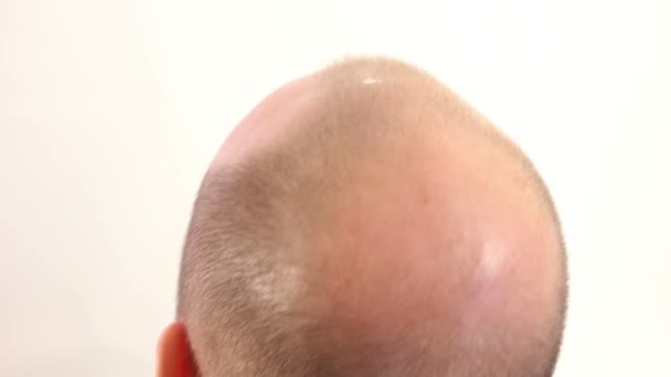 Bald Spot na cabeça masculina — Vídeo de Stock