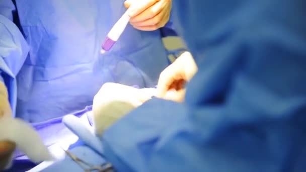 Een kind ondergaat chirurgie — Stockvideo