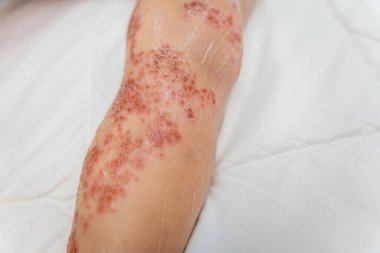 Bebek vücudundaki enterovirüsü kapat