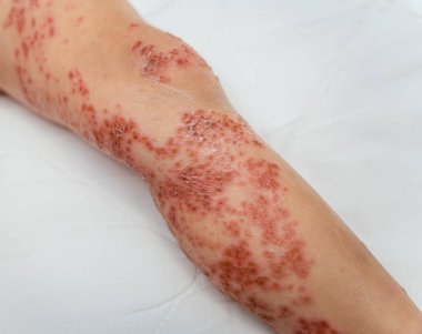 Bebek vücudundaki enterovirüsü kapat