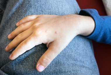 Chickenpox on little boy hand clipart