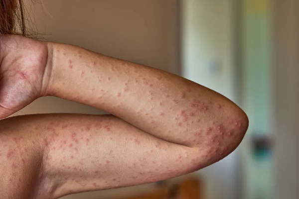 Allergic rash on the body of the patient. 5 year old girl. — Stock Photo, Image