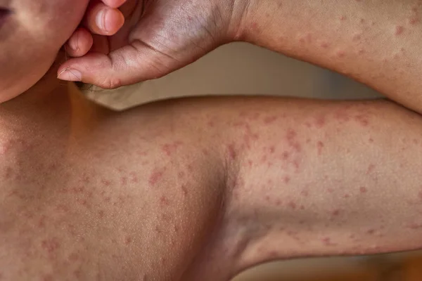 Alergická vyrážka na těle pacienta. 5 letá dívka. — Stock fotografie