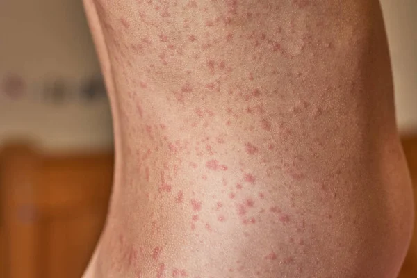 Erupción alérgica en el cuerpo del paciente. Niña de 5 años. —  Fotos de Stock