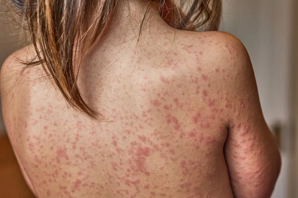 Erupción alérgica en el cuerpo del paciente. Niña de 5 años. —  Fotos de Stock