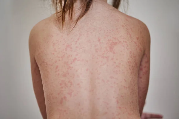 Erupção alérgica no corpo do doente. Menina de 5 anos. — Fotografia de Stock