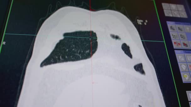 El resultado de una exploración de los pulmones en una tomografía computarizada. Modelo pulmonar en una pantalla de computadora. Tomografía computarizada Coronal MIP. Ver con técnica de filtro pulmonar para diagnóstico TB, tuberculosis y covid-19 — Vídeo de stock