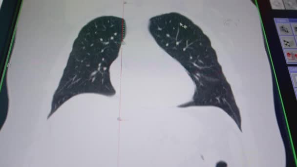 計算されたトモグラフィー上の肺のスキャンの結果.コンピュータ画面上の肺モデル。CT胸コロナMIP 。結核、結核、およびcovid-19を診断するための肺フィルター技術を用いた見解 — ストック動画