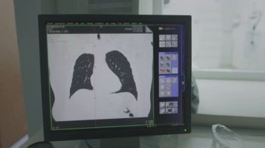 Bilgisayarlı bir tomograftaki akciğerlerin taranmasının sonucu. Bilgisayar ekranında akciğer modeli. CT Göğüs Koronal MIP. Tüberküloz, tüberküloz ve covid-19 teşhisi için akciğer filtresi tekniği ile görüntüle