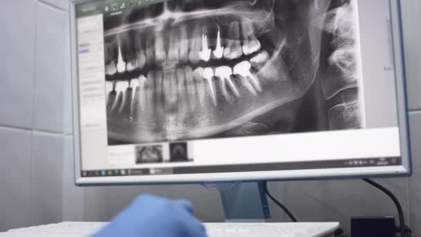 Zubní lékař vyšetřuje panoramatický rentgen čelisti na obrazovce počítače. Lékař ukazuje 3D model úst pacientů, MRI scan — Stock video