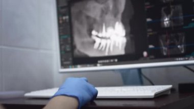 Dişçi bir bilgisayar ekranında çenenin panoramik röntgenini inceliyor. Modern bir diş kliniğinde diş tanılama ekipmanları.