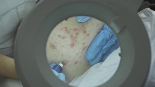 Procedimiento cosmetológico, operación. El médico trata la piel problemática con granos y acné. Láser para una piel sana. — Vídeo de stock