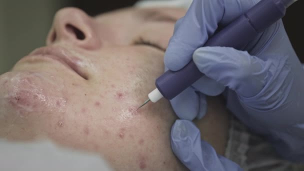 Cosmetologische procedure, operatie. De arts behandelt probleemhuid met puistjes en acne. Laser voor een gezonde huid — Stockvideo