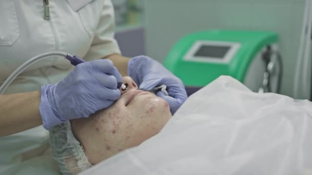 Cosmetologische procedure, operatie. De arts behandelt probleemhuid met puistjes en acne. Laser voor een gezonde huid — Stockvideo